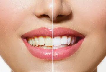 professional teeth whitening in San Diego, CA 92115